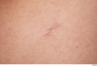 Donna nude scar skin 0001.jpg